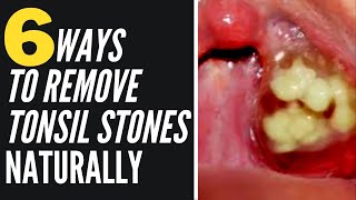 Removing Tonsil Stones At Home [upl. by Artus583]