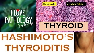 HASHIMOTOS THYROIDITIS Etiopathogenesis Morphology amp Complications [upl. by Aryamo866]