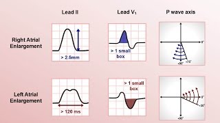 Intro to EKG Interpretation  Chamber Enlargement [upl. by Merideth684]