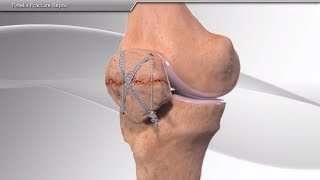 Patella Fracture Repair [upl. by Nuzzi]