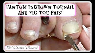 Ingrown Toenail Big Toe Pain Remedy Pedicure Tutorial [upl. by Aikahs520]