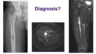 Bone Tumor Causes Signs and Symptoms Diagnosis and Treatment [upl. by Eey]