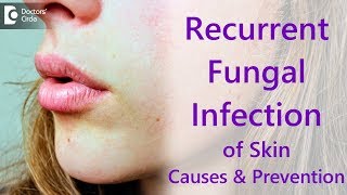 Why do i get recurrent fungal skin infections  Dr Amee Daxini [upl. by Ylatan398]