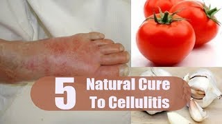 5 Home Remedies for Cellulitis  By Top 5 [upl. by Ikey]