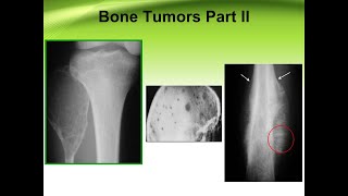 Bone tumors part II [upl. by Josepha]