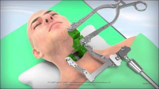 CS1600L Cervical Retractor Animation [upl. by Akkire]