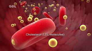 Arteriosclerosis [upl. by Camm]