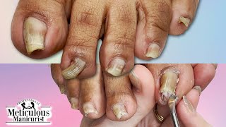 👣Curling Wavy PINCHING TOENAILS How to Clean amp Restore👣 [upl. by Lobel]