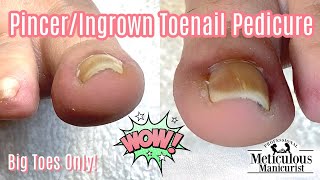 HOW TO REVERSE AND CURE PINCER TOENAILS [upl. by Callida]