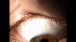 Contact Lenses  SCL Assessment of fit amp Removal [upl. by Annav]