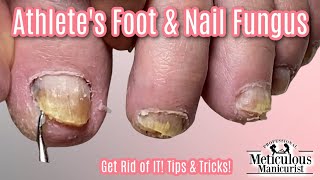 Reverse Nail Fungus Caused by Athletes Feet [upl. by Omsoc]