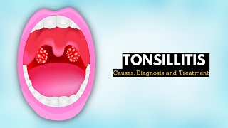 Tonsillitis Causes Signs and Symptoms Diagnosis and Treatment [upl. by Alisha]