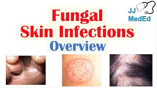 Overview of Fungal Skin Infections  Tinea Infections [upl. by Dempsey]