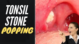 Tonsil Stone Removal  Popping Tonsil Stones [upl. by Odlavso]