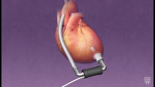 Mayo Clinic Minute How ventricular assist devices can help heart patients [upl. by Uwkuhceki]