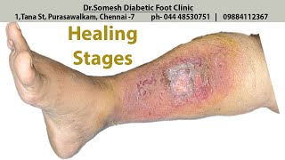 Cellulitis Infection healing stages [upl. by Duvall]