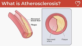 What is Atherosclerosis [upl. by Nahttam835]