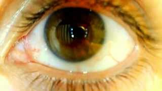 Physiologic optokinetic nystagmus [upl. by Lopes349]