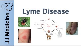 Lyme Disease  Pathophysiology Signs and Treatment [upl. by Geminian]