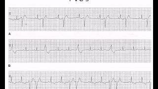 Easy EKG Premature Ventricular Contractions and Atrial Fibrillation [upl. by Kyd]