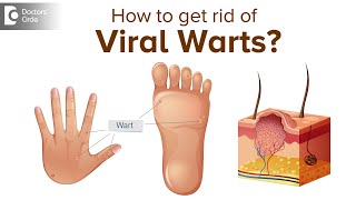 What are Viral Warts and what do we need to know about it  Dr Divya SharmaDoctors Circle [upl. by Hwang]