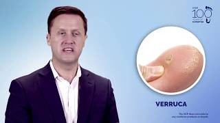 Understand and Manage Wart amp Verruca [upl. by Gawain870]