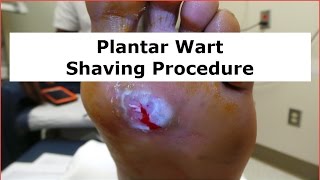 Plantar Wart Shaving Procedure [upl. by Fariss]