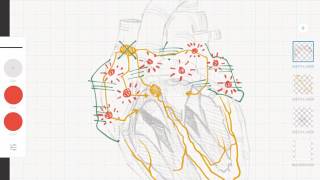 Cardiología y ECG Taquicardias supraventriculares vs ventriculares [upl. by Rehpotisrhc984]