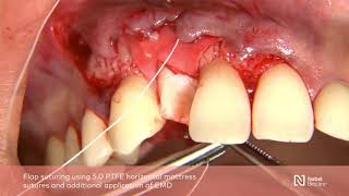 Guided bone regeneration with simultaneous implant placement [upl. by Adalia398]