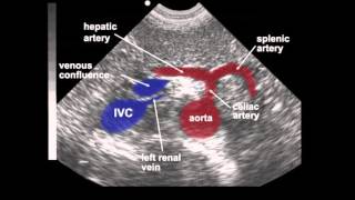 Rotarex™ Rotational Excisional Atherectomy System [upl. by Eanaj102]