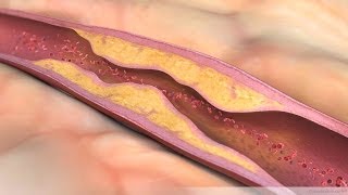 Aortic Stenosis  Overview signs and symptoms pathophysiology treatment [upl. by Nyret]