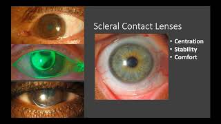 Specialty Contact Lenses Corneal Rigid Gas Permeable RGP Lenses [upl. by Nywnorb229]